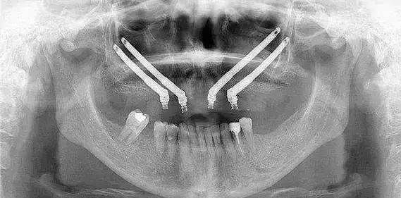 Implantes cigomáticos en Madrid: solución para pacientes sin hueso