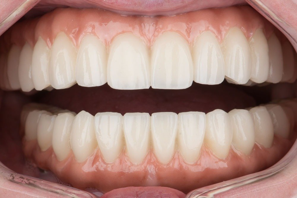 Ana – Implantes Cigomáticos